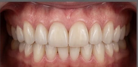 After treatment