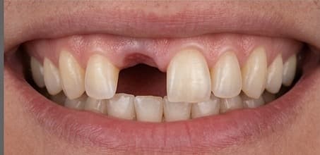 Before treatment