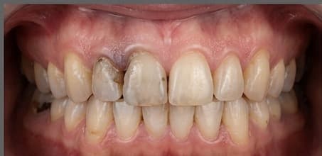 Before treatment